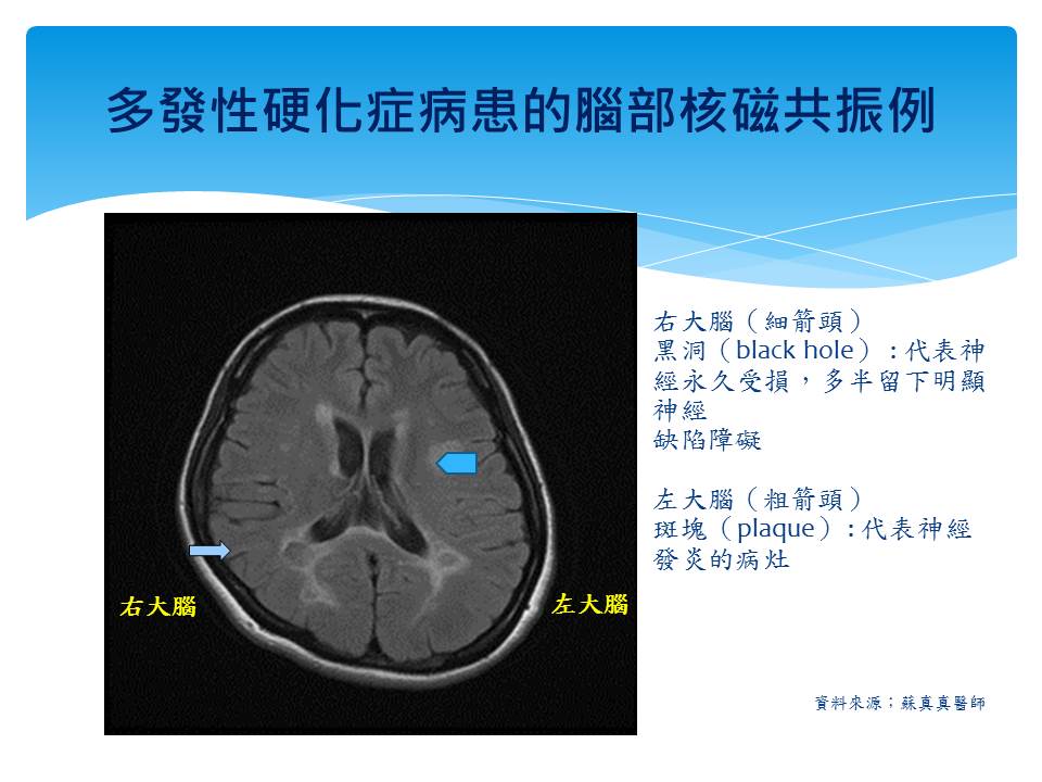圖一　多發性硬化症病患的腦部核磁共振例。右大腦(細箭頭)黑洞：代表神經永久受損，多半留下明顯神經缺陷障礙。右大腦(粗箭頭)斑塊：代表神經發炎的病灶。