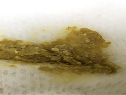 不正常大便；6號便大便顏色偏淺黃；部分可看到明顯灰白便
