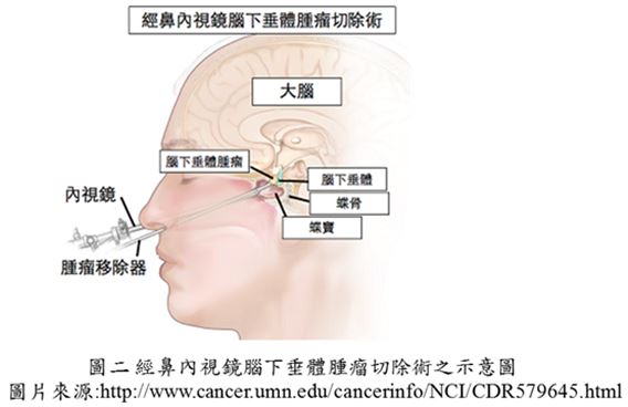 圖二、經鼻內視鏡腦下垂體腫瘤切除術