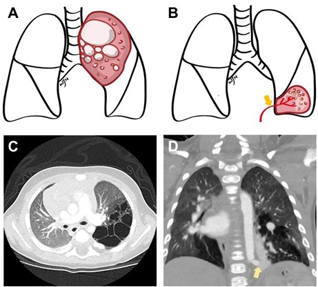 先天性肺部呼吸道畸形（CPAM）：最常見的肺部發育異常│臺大醫院外科部 