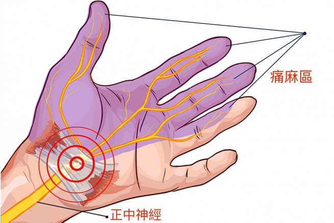 腕隧道症候群